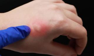 为什么有些人招蚊子 为什么有些人招蚊子